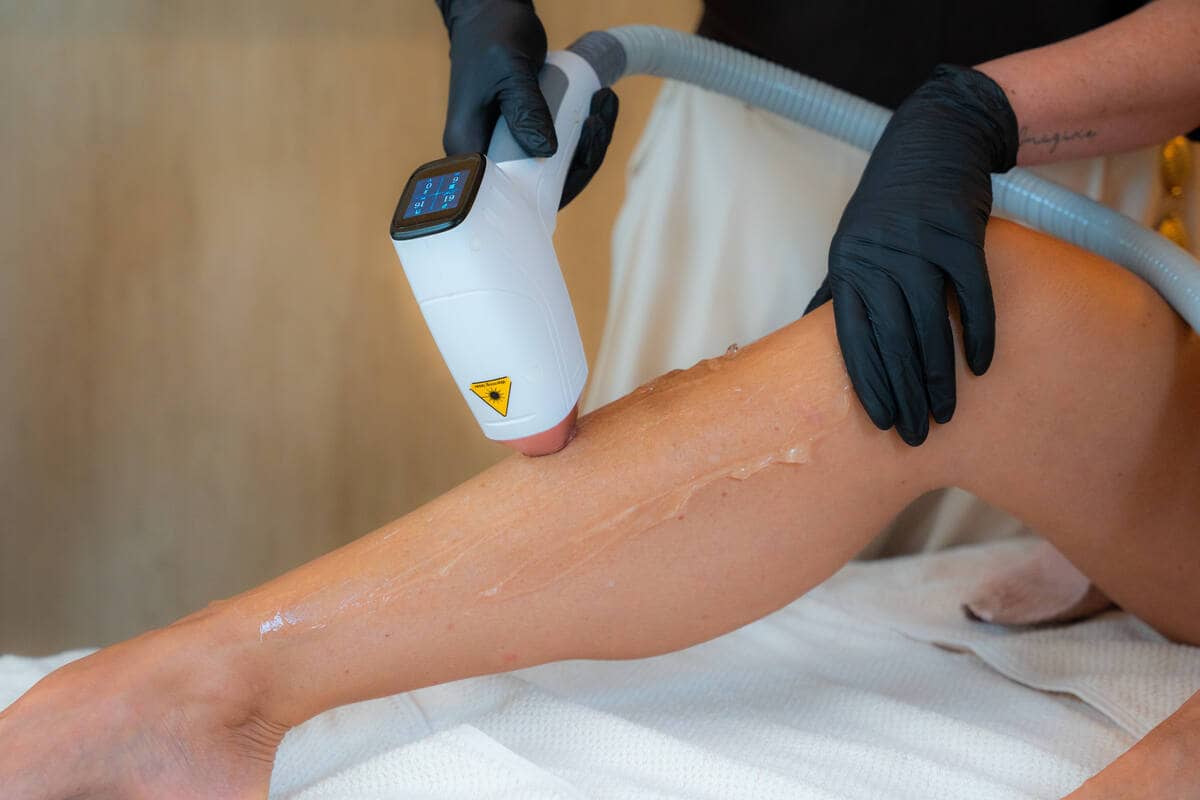 Behandeling van het onderbeen met de diode ICE laser