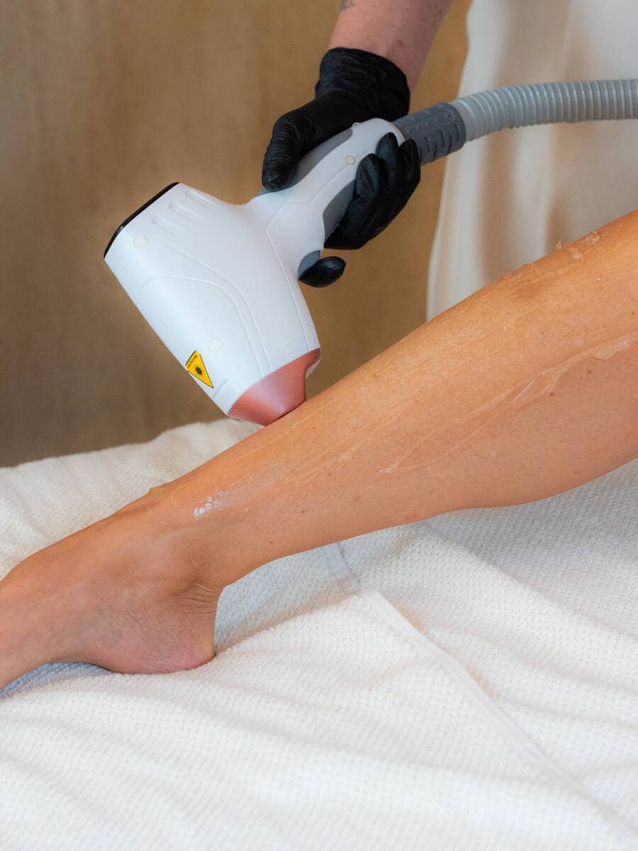 Benen laseren met de diode ICE laser bij Beauty by Sheron