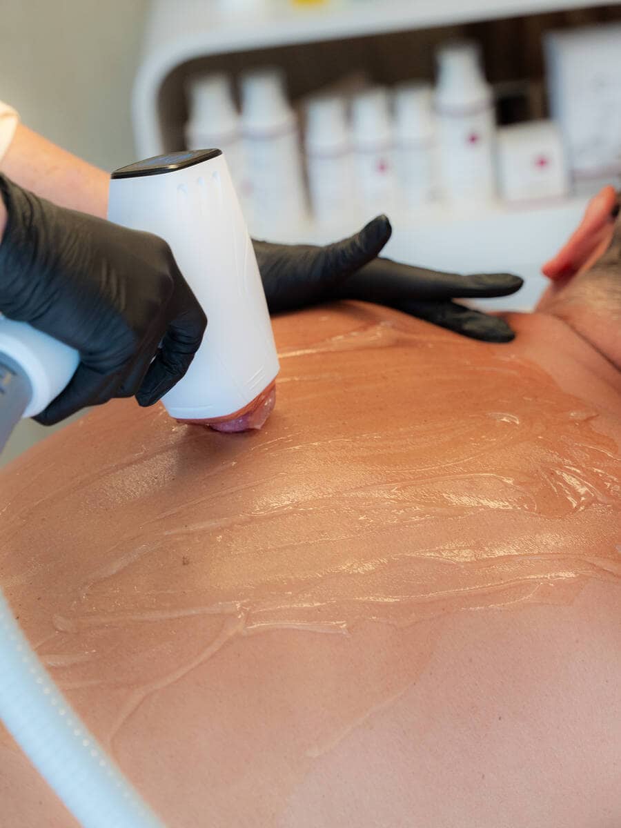 Rug laseren met de diode ICE laser bij Beauty by Sheron